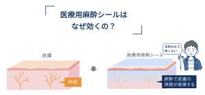 医療用麻酔テープの仕組み