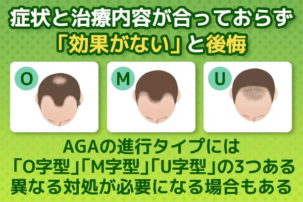 AGAには「O字型」「M字型」「U字型」の３つがあり異なる対処が必要であることを示す画像